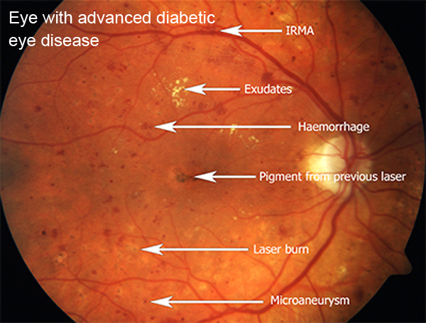 eye with advanced diabetic disease