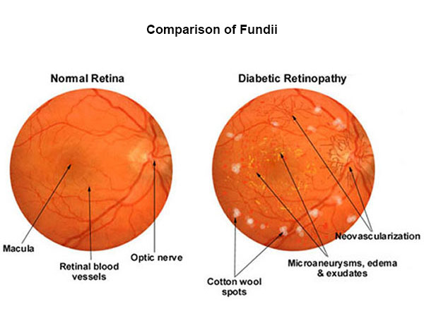 comparison of normal retina and diabetic retinopathy (fundus photography)
